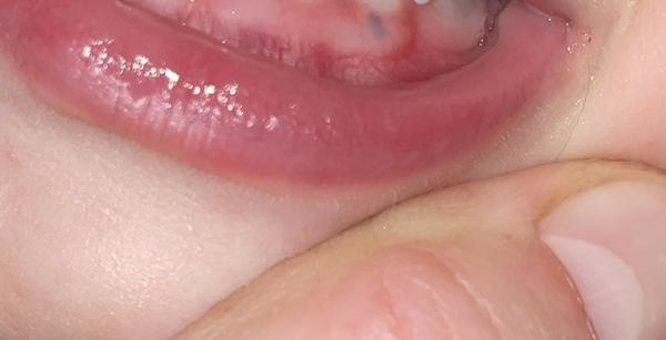 Čo môže byť pod ďasnom u 22-mesačného dieťaťa?