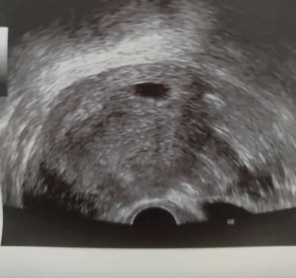 Som na začiatku tehotenstva a hrozí mi anembryola