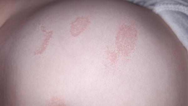 Aké fľaky to má moja 10 mesačná dcérka na tele?