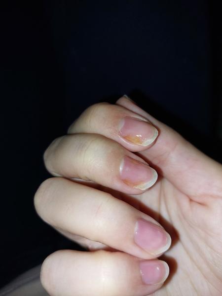 Je to mykóza nechtov?