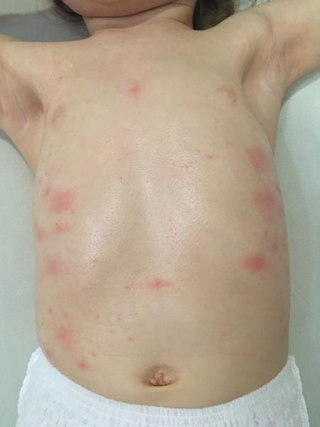 Dlhodobé vyrážky po chorobe u dieťaťa