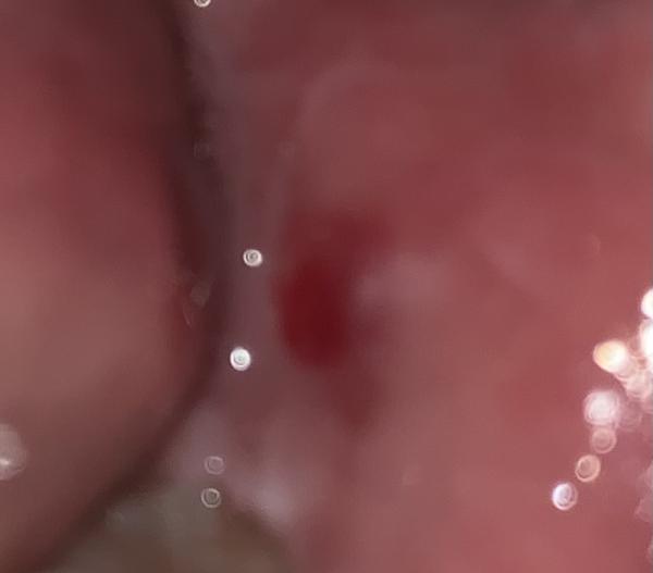 Čierny "vačok” v ústach