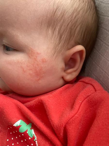 Aký výsyp má moja dcérka na líčkach?