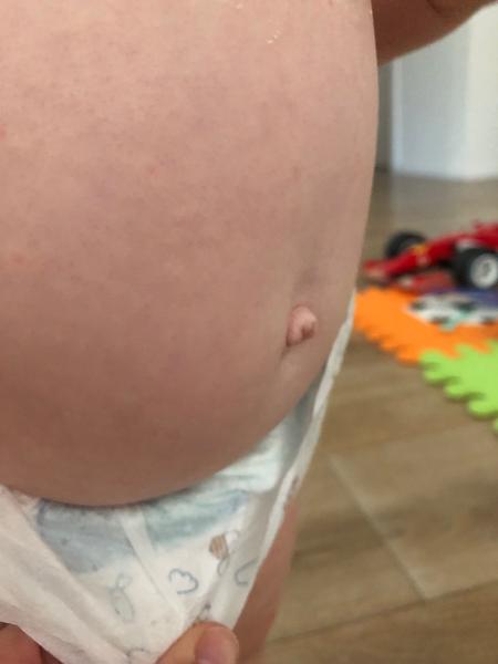 Má môj 13-mesačný synček pruh?