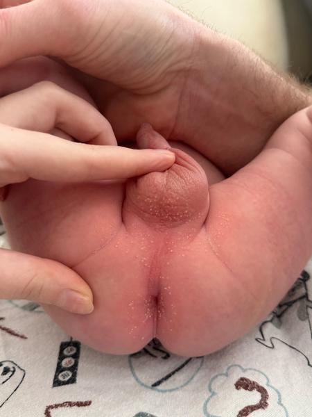 Plienková dermatitída