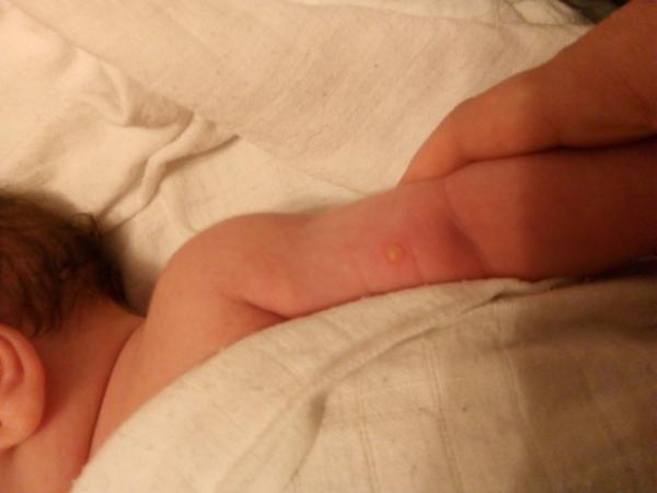 Z čoho má syn pľuzgier na rúčke?