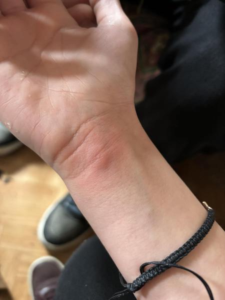 Od čoho môžu byť štípance na tele?