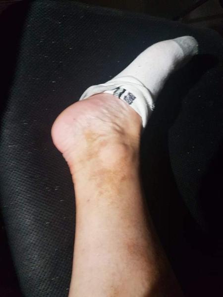 Praskanie drobných ciev - máte s tým skúsenosti?