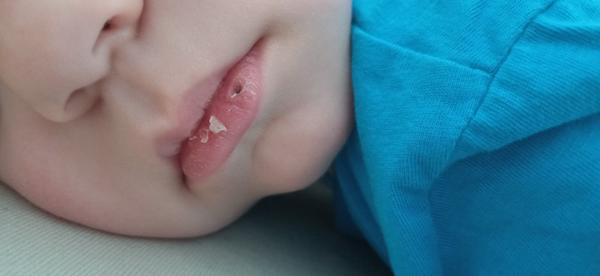 Ako liečiť popraskané pery u dvojročného dieťaťa?