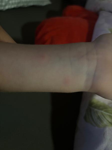 Môžu to byť kiahne?