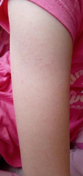 Ako sa zbaviť vyrážok na rukách dieťaťa?