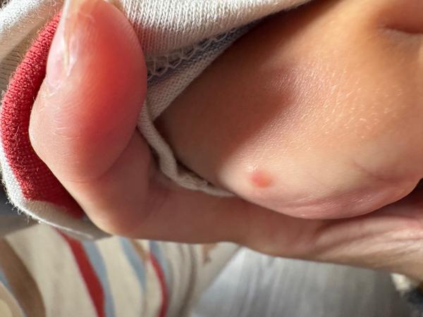 Vyrážka na ruke dieťaťa