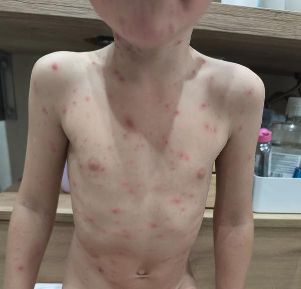 Samoliečba kiahní: -Fenistil a hypermangán