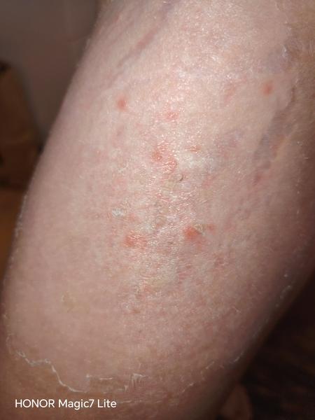 Čo spôsobilo vyrážky po návrate z Turecka?