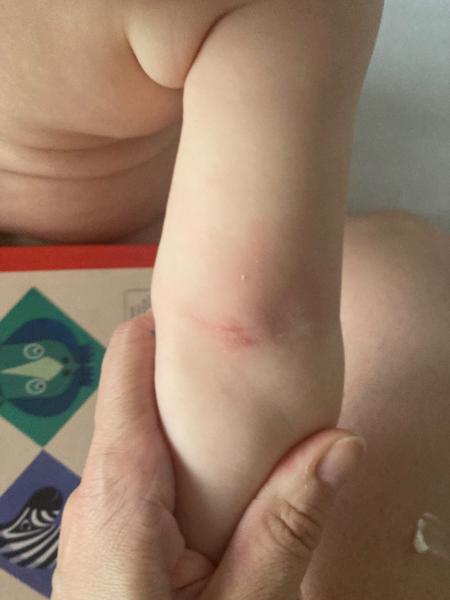 Moja 9-mesačná dcérka si škriabe vnútornú stranu rúčky