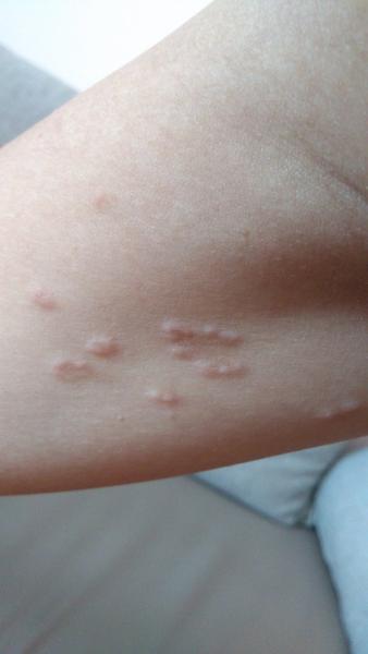 Ako liečiť výsyp v podpazuší?