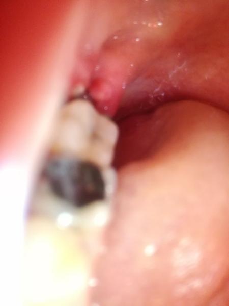 Opuch sánky. Môže ísť o zápal okostnice?