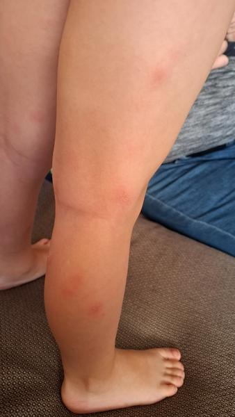 Je impetigo zodpovedné za synove príznaky?