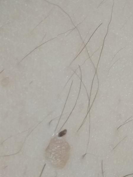 Čo môže byť výrastok na znamienku?