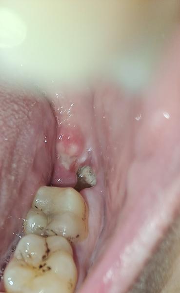 Bolesť po extrakcii dolnej osmičky: Ako ju zvládnuť?