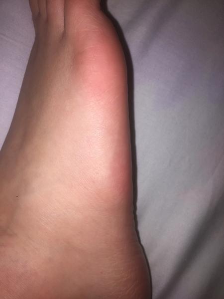 Bolesť chodidla - mám zápal šliach?