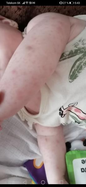 Bábätko má zvláštne vyrážky
