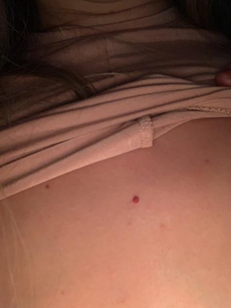 Odstránenie-petéchie