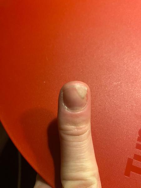 Oddeľuje sa mi necht od lôžka