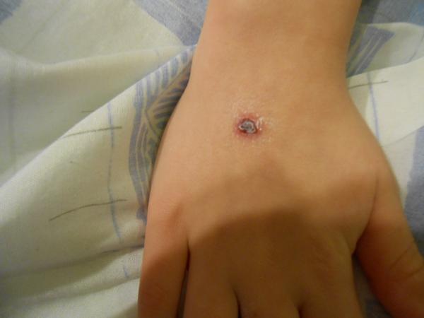 Čo s tmavou kiahňou?