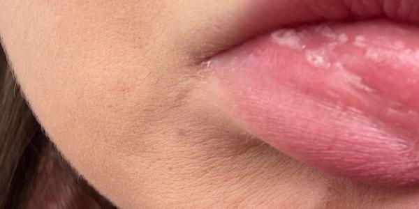 Čo znamená vyrážka na perách?