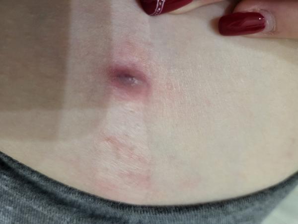 Čo robiť, keď sa na strii objaví bolestivé miesto?