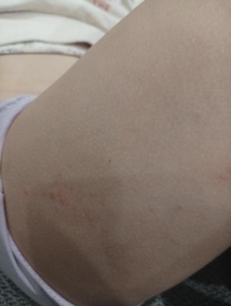 Svrbiace vyrážky na nohách