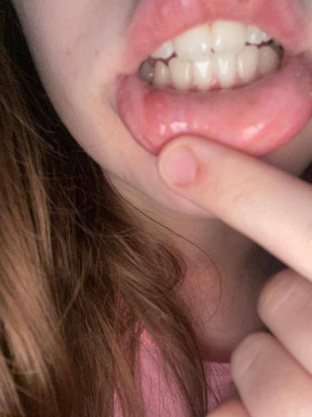 Hrčka na spodnej pere