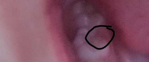 Zlomila sa mi časť zadného zuba