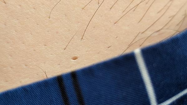 Nebolestivá dierka v koži