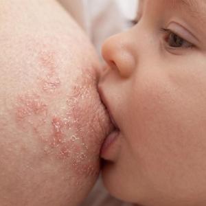 Vracia sa žaba/soor opakovane? Pozrite sa, čo musíte zmeniť!