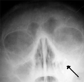 Rhinoplastika - RTG