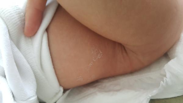 Biele fľaky na 2-mesačnom bábätku.