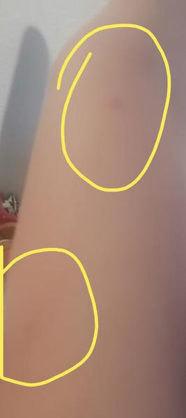 Aké sú to vyrážky?