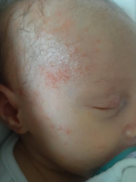 Červené vyrážky na tvári bábätka