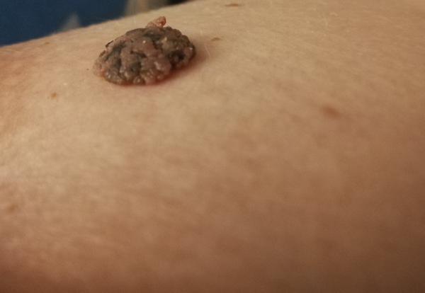 Ako sa zbaviť bradavice v tehotenstve?