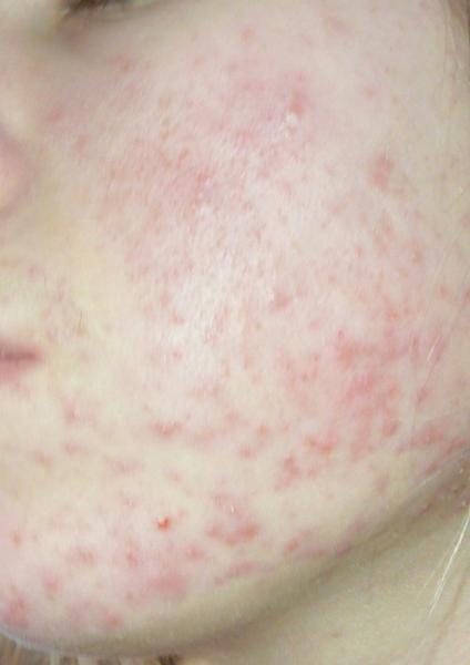 Ako sa účinne zbaviť problematického akné?