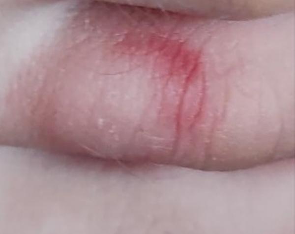 Je to príznak boreliózy alebo niečo iné?