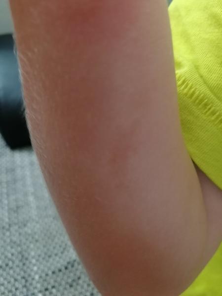 Hnedè fľaky na pokožke