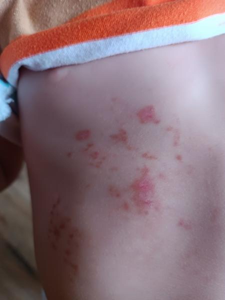 Chrasty na brušku: Je to reakcia na hmyz?