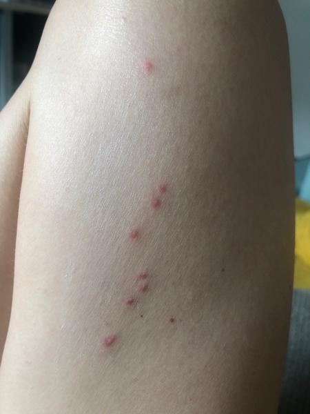 Od akého hmyzu sú tieto štípance?