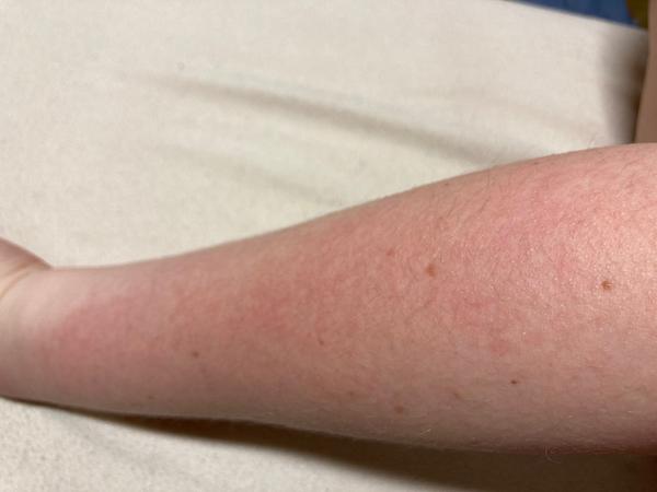 Aký výsyp mám na ruke?