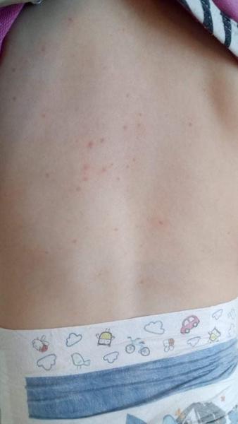 Sú to štípance alebo alergia?