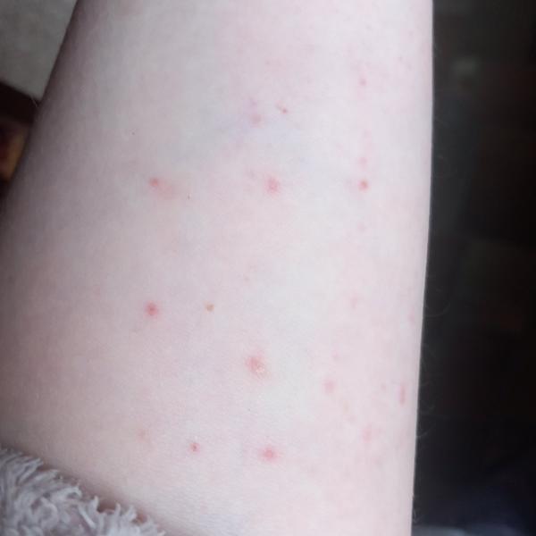 Čo spôsobuje vodnaté vyrážky na tele?