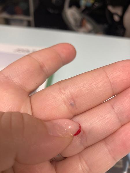 Mám po páde na prste zrazeninu?